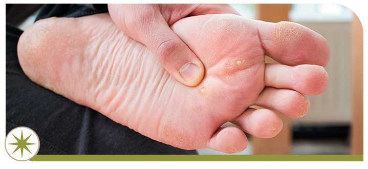 Wart Removal Specialist Near Me in Granville, OH Wart Removal Specialist Near Me in Granville, OH