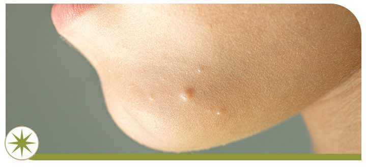 What Is the Main Cause of Warts Near Me in Granville OH? What Is the Main Cause of Warts Near Me in Granville OH?
