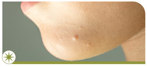 What Is the Main Cause of Warts Near Me in Granville OH? What Is the Main Cause of Warts Near Me in Granville OH?