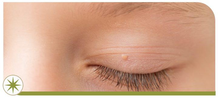 Warts Treatment Specialist in Park Ridge, OH