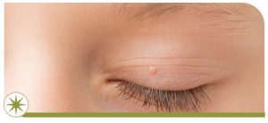 Warts Treatment Specialist in Park Ridge, OH